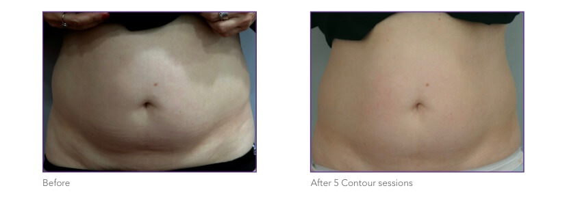 CONTOUR-ENDYMED2