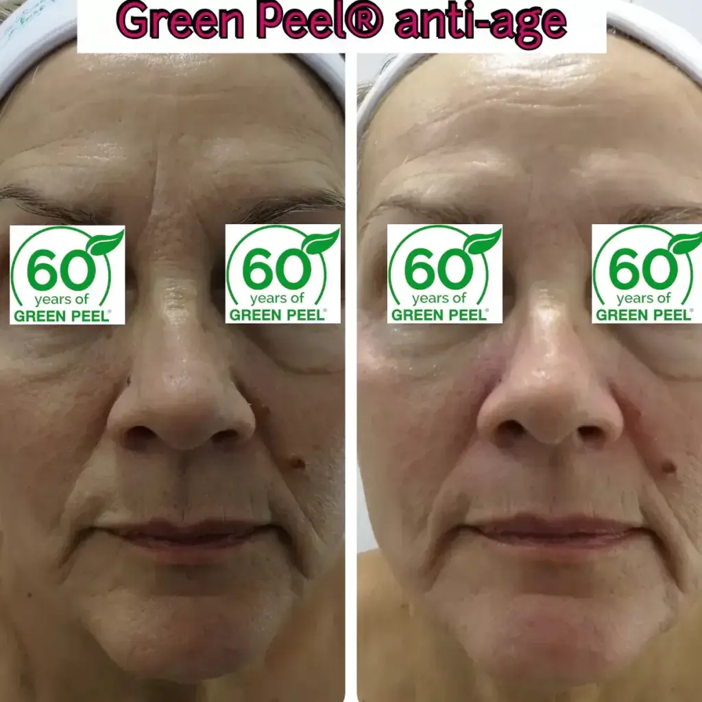 Green-Peel-antiage-2 Green-Peel-antiage-2
