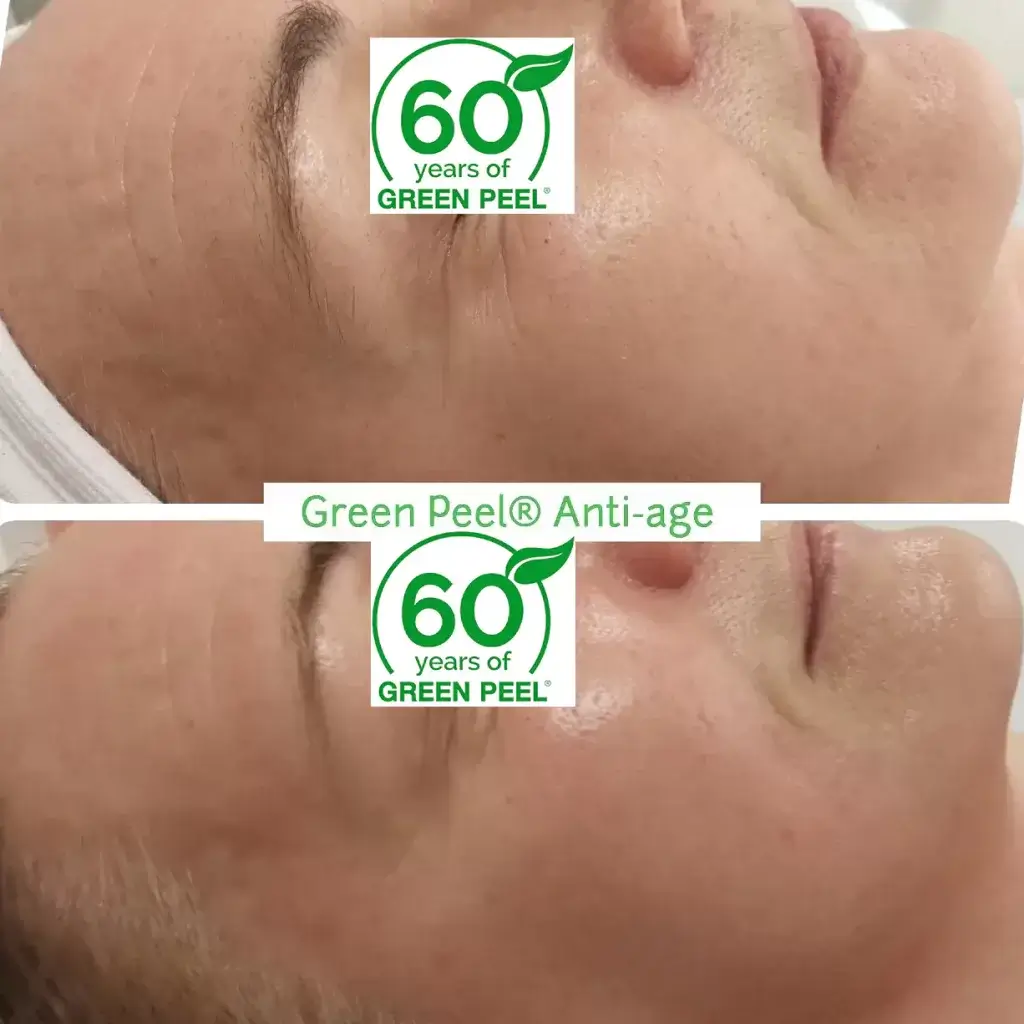 Green-Peel-antiage Green-Peel-antiage