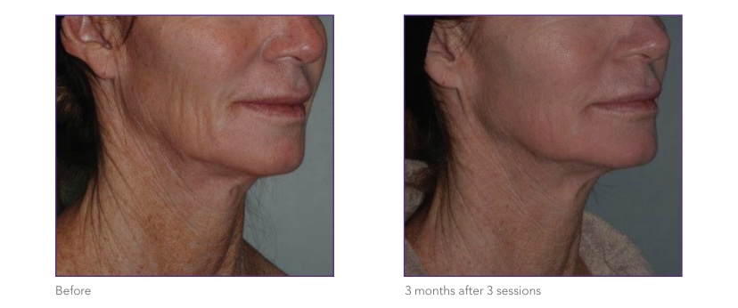 INTENSIF–RF-MICRONEEDLING4