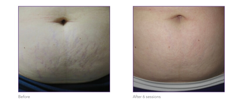 INTENSIF–RF-MICRONEEDLING5