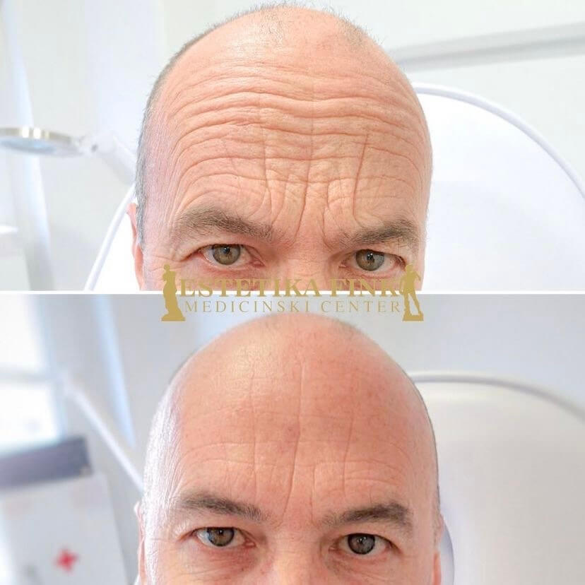 estetika-fink-botulin-toksin.jpeg estetika-fink-botulin-toksin.jpeg