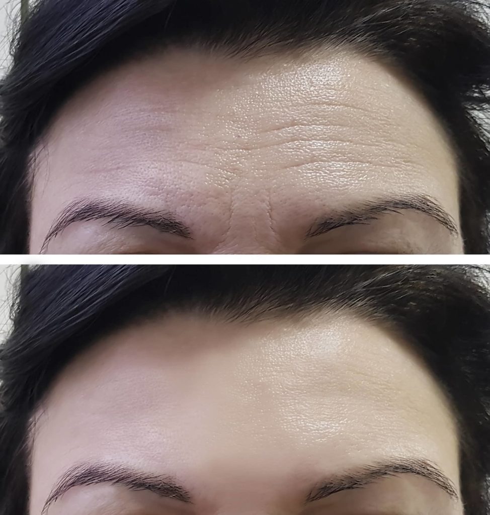 forehead-women-wrinkles-before-and-after forehead-women-wrinkles-before-and-after
