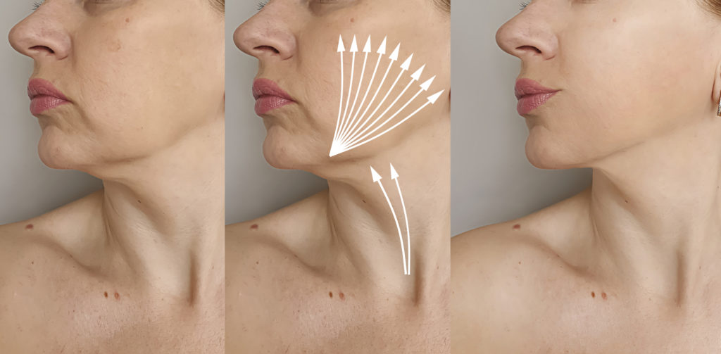 woman-double-chin-before-after-treatment