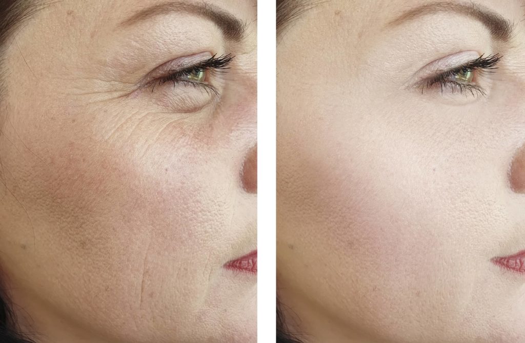 woman-wrinkles-face-beautician-effect-therapydifference-regeneration-before-and-after-treatments woman-wrinkles-face-beautician-effect-therapydifference-regeneration-before-and-after-treatments